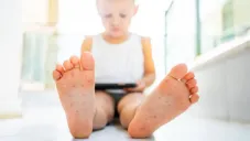 Alerta por brote de virus Coxsackie en niños: qué debes saber