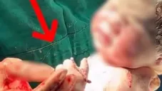 ¡Increíble! Bebé nace sosteniendo el DIU que debía evitar su embarazo