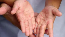 Suspenden festejos de Día de Muertos por brote del virus Coxsackie