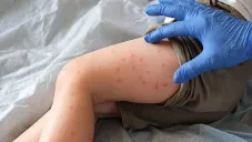 Alerta en México por brote de sarampión: Síntomas, cómo prevenir la enfermedad y estados con más casos