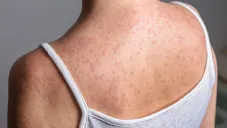 ¿Estás en riesgo por el sarampión? Esto dice la UNAM sobre adultos mayores y vacunación